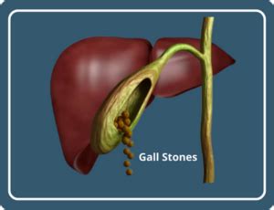 Gallbladder Stones Treatment at Home: Ayurvedic Treatment