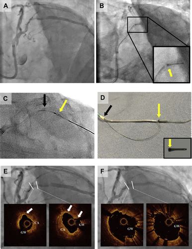 Successful Retrieval Of A Fractured And Detached Crown From A Coronary