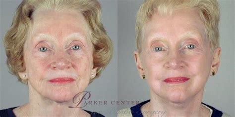 Facelift Before And After Photo Gallery Paramus Nj Parker Center For Plastic Surgery