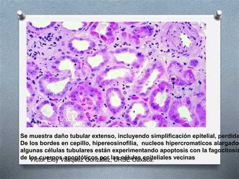 Necrosis Tubular Aguda Ppt