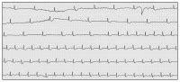 Abbildungen Und Graphiken EKG Beispiel AV Block II Typ Mobitz