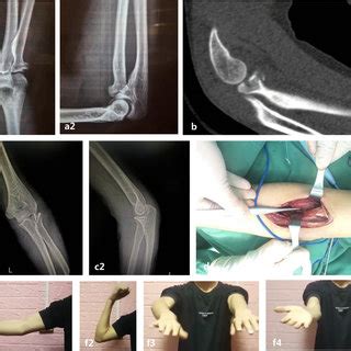 A 40 Year Old Man Presented With A Regan And Morrey Type II Coronoid