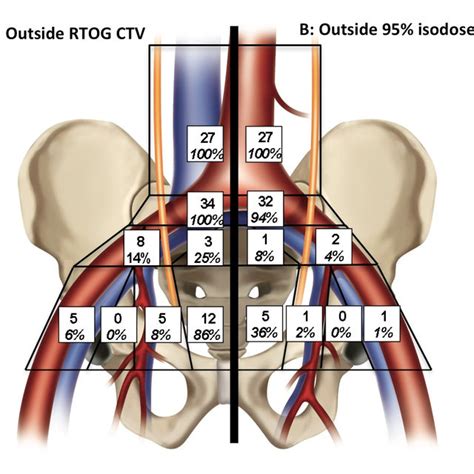 Anatomical Distribution Of Sentinel Lymph Nodes Sln By Download Scientific Diagram