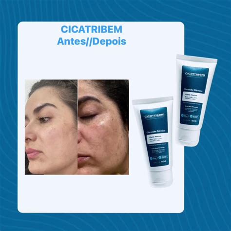 Cicatribem Antes E Depois - Resultados Antes e Depois do Cicatribem | TikTok