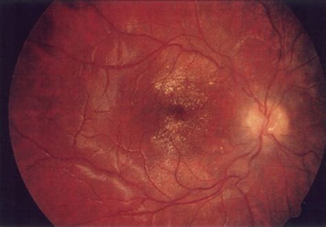 Old Retinal Vasculitis