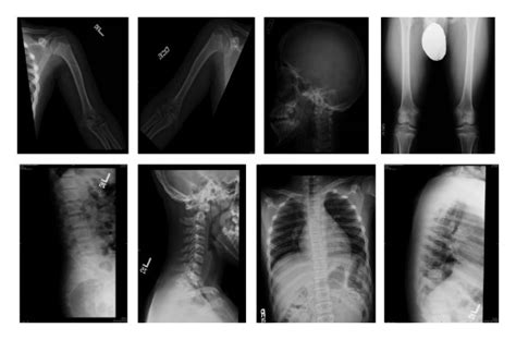 Patients Skeletal Survey In Favor Of Hypochondroplasia Download