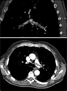 Pulmonary embolism - Wikipedia