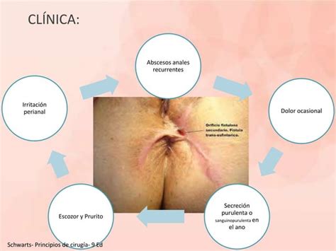 ABSCESOS FISTULAS ANORECTALES ENFERMEDAD PILONIDAL PPT