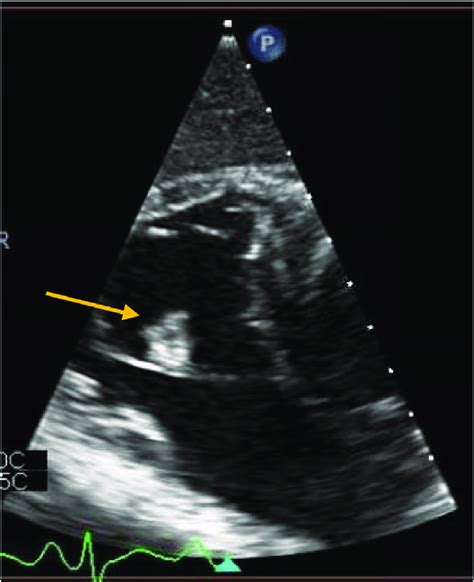 Transesophageal Echocardiography Showing Rectangular Shaped Vegetation Download Scientific