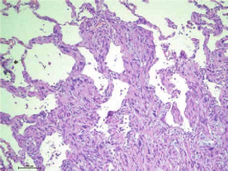 Interstitial Growth At The Surface Of A Leiomyosarcoma Metastasis