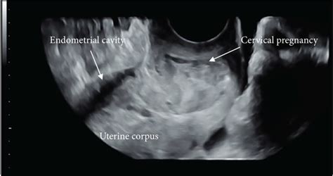 Cervical Ectopic Pregnancy In A 2D And B 3D Transvaginal Ultrasound