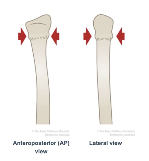 Buckle Greenstick Fracture Of The Distal Radius Sports Medicine Review