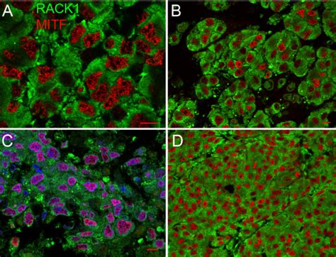 Rack1 In Human Melanoma Metastasis Confocal Microscopy Analysis Of Download Scientific Diagram