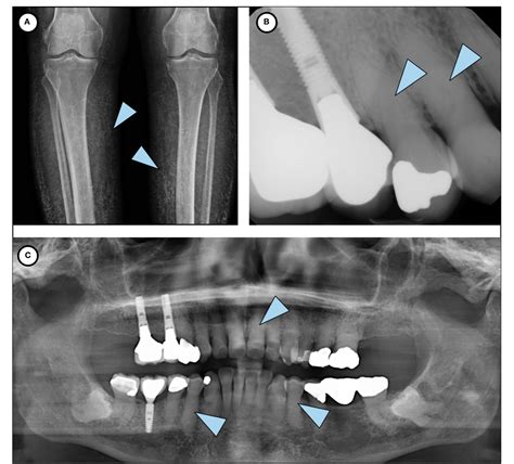 Figure From Hyperphosphatemic Familial Tumoral Calcinosis Hidden In