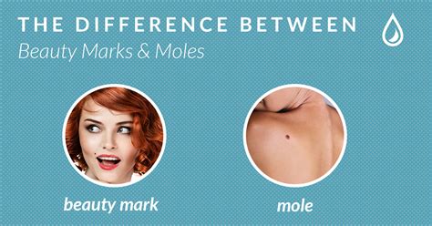 How To Tell The Difference Between A Mole And A Freckle 2024