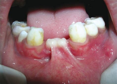 Intraoral Photograph Showing Edentulous Mandibular Central Incisor