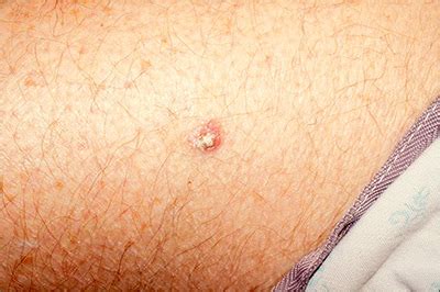 Rough lesion on the thigh | MDedge