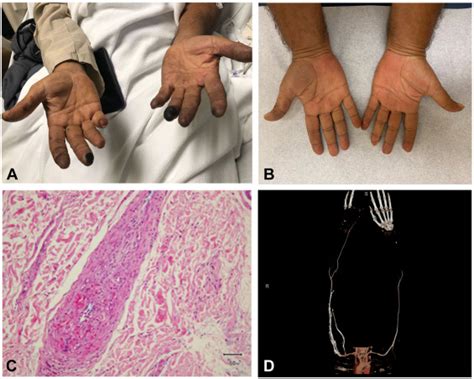 Digital Ischemia As A Presenting Feature Of Hypereosinophilic Syndrome