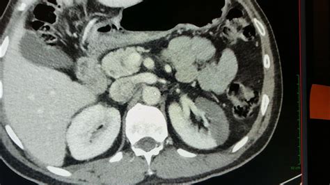 Ct Scan Of Renal Infarct Youtube