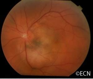 Choroidal Melanoma New York Eye Cancer Center