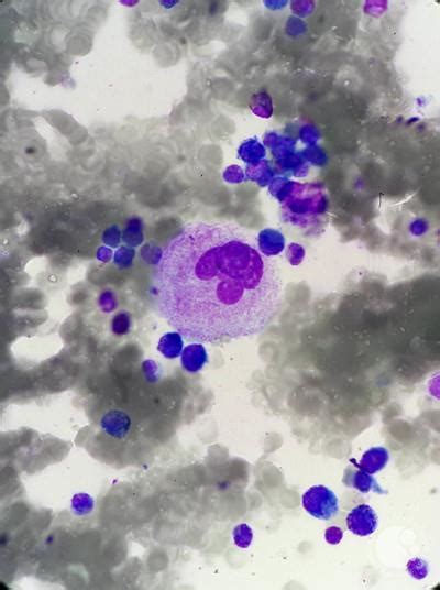 Itp Megakaryocyte Morphology 1