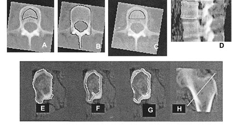 Figure 1 From Quantitative Computed Tomography Reveals The Effects Of