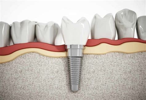 Dental Implants Procedure: How Does It Work?