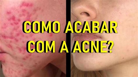 Kit Acnezil Tratamento Completo Para Acne Elimina Cravos E Espinhas