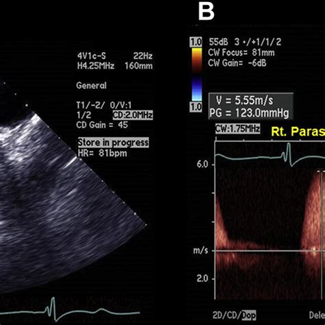 A Transthoracic Echocardiography D And Color Flow Doppler