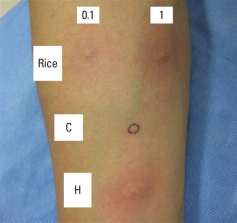 Result Of The Skin Prick Test Showing A Positive Response To Rice