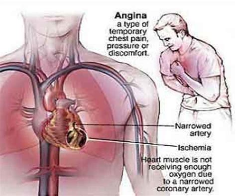 Blocked Artery Symptoms & Silent Heart Attacks | hubpages