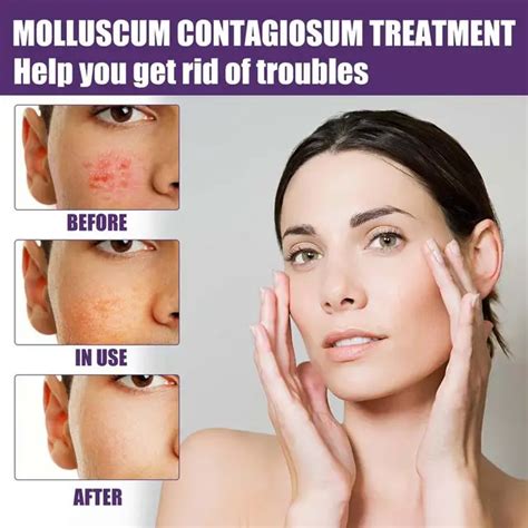 What Is Molluscum Contagiosum Treatment And Home Remedies 54 Off