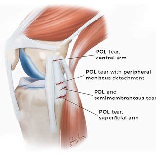 Physical Examination Of A Combined SMCL POL Injury A Valgus Stress