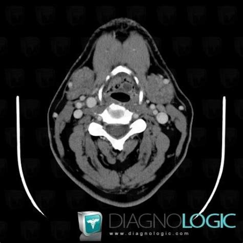 Radiology case : Epiglottic cyst (CT) - Diagnologic