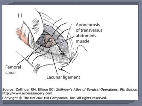 Hernia femoral