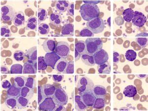 Leucemia Miel Ide Cr Nica Atlas Em Hematologia