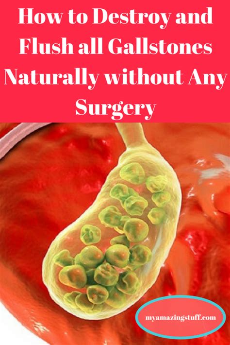 How To Destroy And Flush All Gallstones Naturally Without Any Surgery My Amazing Stuff