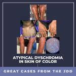 Atypical Dyschromia In Skin Of Color Next Steps In Dermatology