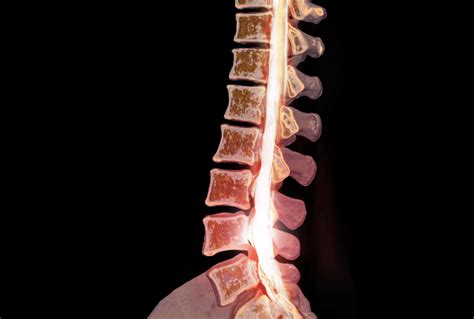 Herniated Disc Symptoms and Treatment Options