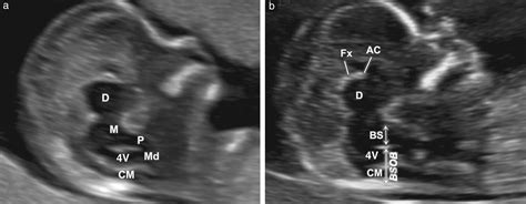 Firsttrimester Fetal Neurosonography Technique And Diagnostic