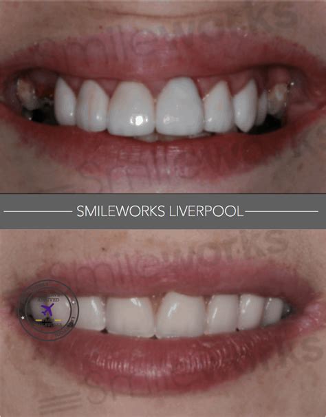 How Much Is A Full Set Of Teeth Implants Uk - TeethWalls