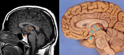 09.1 Diencephalon MRI Diagram | Quizlet