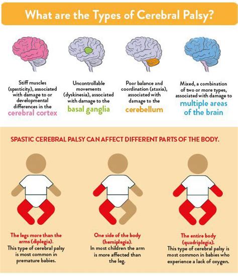 Infographic Understanding Cerebral Palsy Gillette Childrens