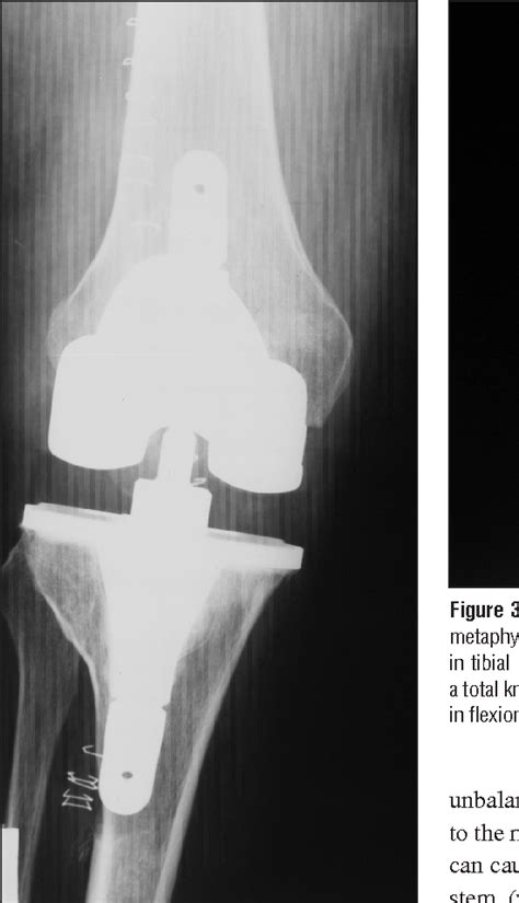 Total Knee Arthroplasty After High Tibial Osteotomy Semantic Scholar