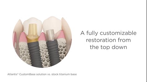 Atlantis Custombase Solution Dentsply Sirona Youtube