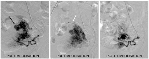 Figure 2 From Uterine Arteriovenous Malformation Semantic Scholar