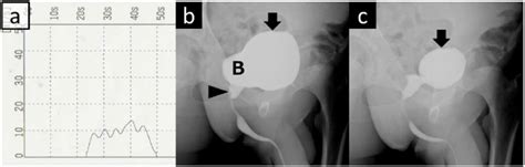 The Findings Of Uroflowmetry And Voiding Cystourethrography Vcug