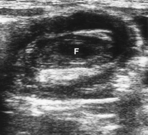 Intussusception In Children Current Concepts In Diagnosis And Enema