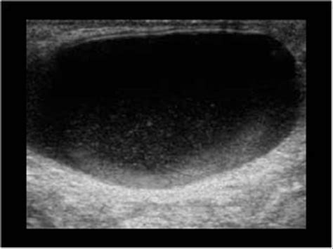 Pediatrics | 9.3 Pediatric scrotum : Case 9.3.1 Hydroceles | Ultrasound ...