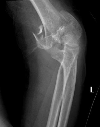 Displaced T Condylar And Supracondylar Fracture Of The Distal Humerus